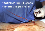Удаление вены через маленькие разрезы
