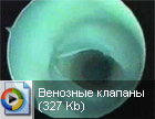 Варикозного расширения вен. Венозные клапаны (327 Kb)