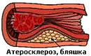 Облитерирующий атеросклероз нижних конечностей, бляшка