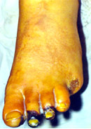 Симптомы заболевания связаны с хронической артериальной недостаточностью нижних конечностей. Больные жалуются на повышенную чувствительность к низкой температуре, усталость в ногах, онемение, судороги, боль при ходьбе или в покое, трофические расстройства в виде язв в области пальцев и стоп, некрозов или гангрены