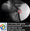 Балонная дилатанция и стентирование внутренней сонной артерии при атеросклерозе