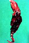 Тромб, извлеченный из легочной артерии
