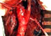 Операции на сонных и позвоночных артериях