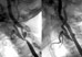 Рентгеноэндоваскулярное расширение (дилатация) и стентирование сонной артерии