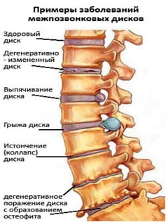 Грыжи межпозвонковых дисков. Остеохондроз