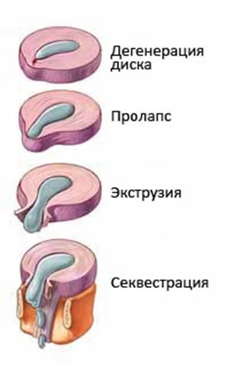 Стадии формирования грыж межпозвонковых дисков по Decolux A.P.(1984)